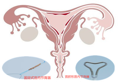 你知道节育环的故事吗？